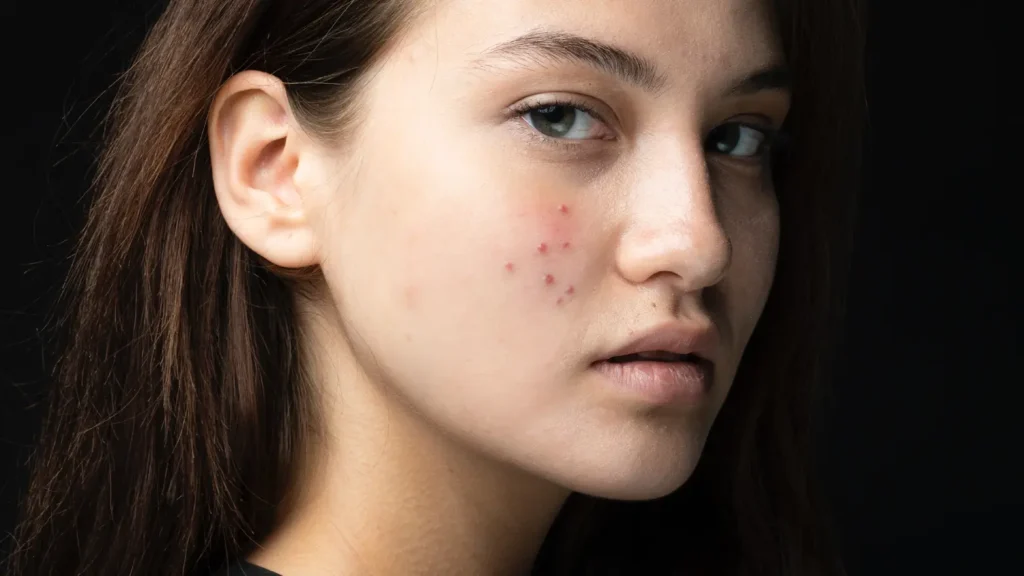 Beautiful woman with acne