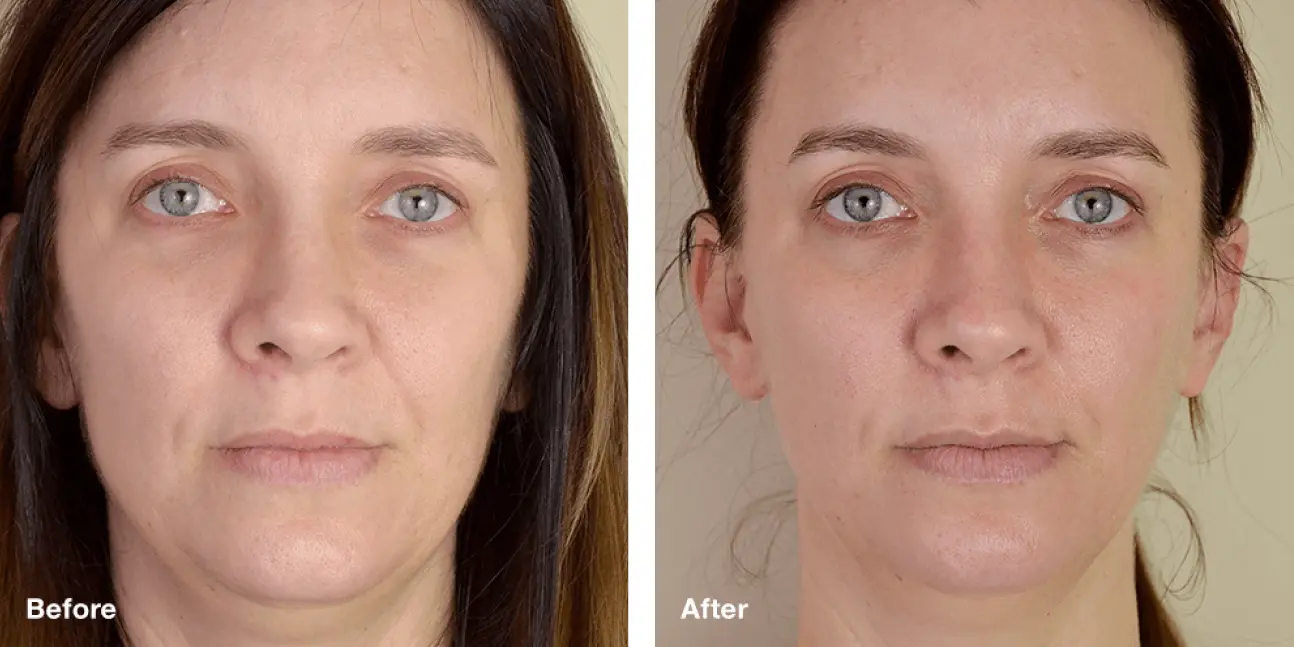 Myotone online Face Toning Tool