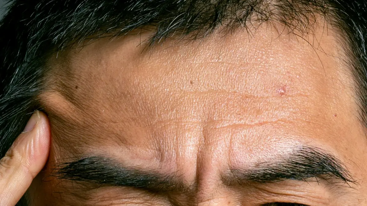 How to Smooth Forehead Wrinkles Naturally